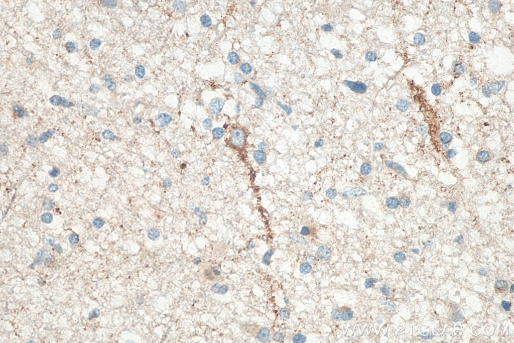 Immunohistochemistry (IHC) staining of human gliomas tissue using RAB3A Polyclonal antibody (15029-1-AP)