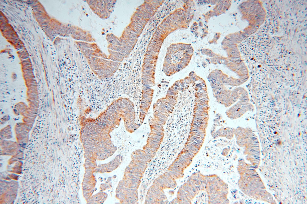 Immunohistochemistry (IHC) staining of human colon cancer tissue using RAB3B/C Polyclonal antibody (15774-1-AP)