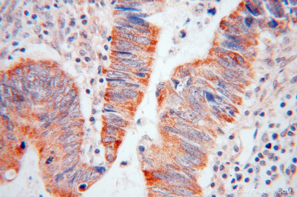 Immunohistochemistry (IHC) staining of human colon cancer tissue using RAB3B/C Polyclonal antibody (15774-1-AP)