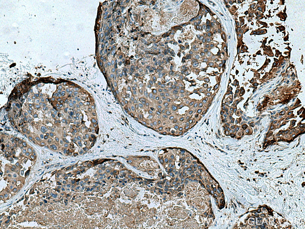 Immunohistochemistry (IHC) staining of human breast cancer tissue using RAB3D Polyclonal antibody (12320-1-AP)