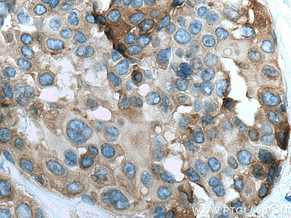 Immunohistochemistry (IHC) staining of human breast cancer tissue using RAB3D Polyclonal antibody (12320-1-AP)