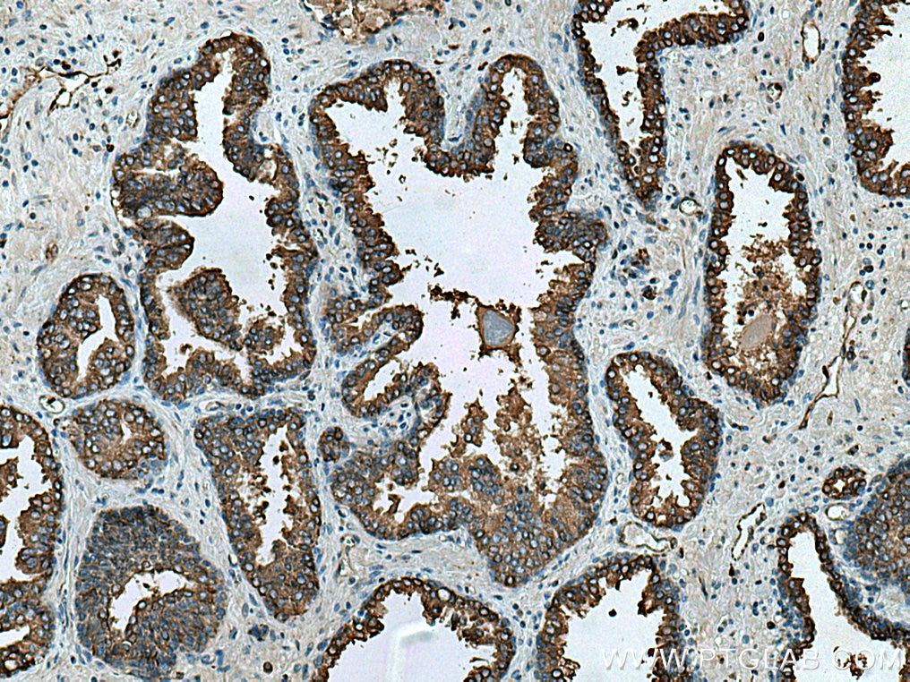 IHC staining of human prostate cancer using 12320-1-AP