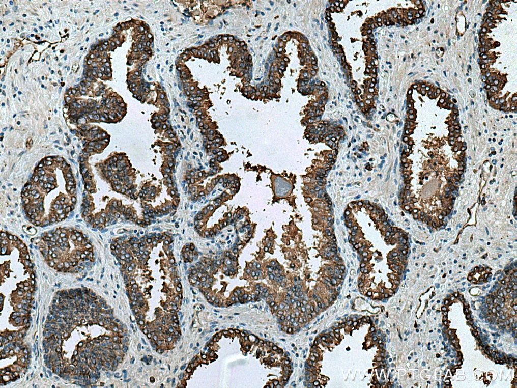 Immunohistochemistry (IHC) staining of human prostate cancer tissue using RAB3D Polyclonal antibody (12320-1-AP)