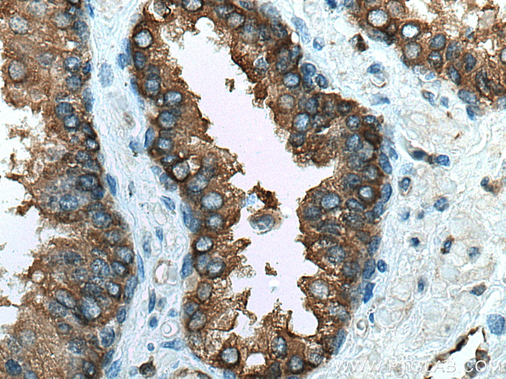 Immunohistochemistry (IHC) staining of human prostate cancer tissue using RAB3D Polyclonal antibody (12320-1-AP)