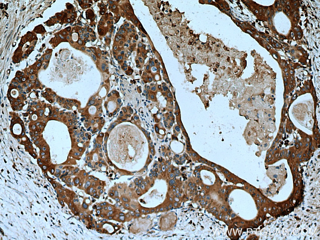 Immunohistochemistry (IHC) staining of human colon cancer tissue using RAB3D Monoclonal antibody (67118-1-Ig)