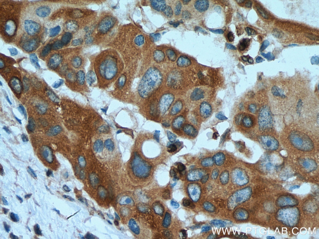 Immunohistochemistry (IHC) staining of human colon cancer tissue using RAB3D Monoclonal antibody (67118-1-Ig)