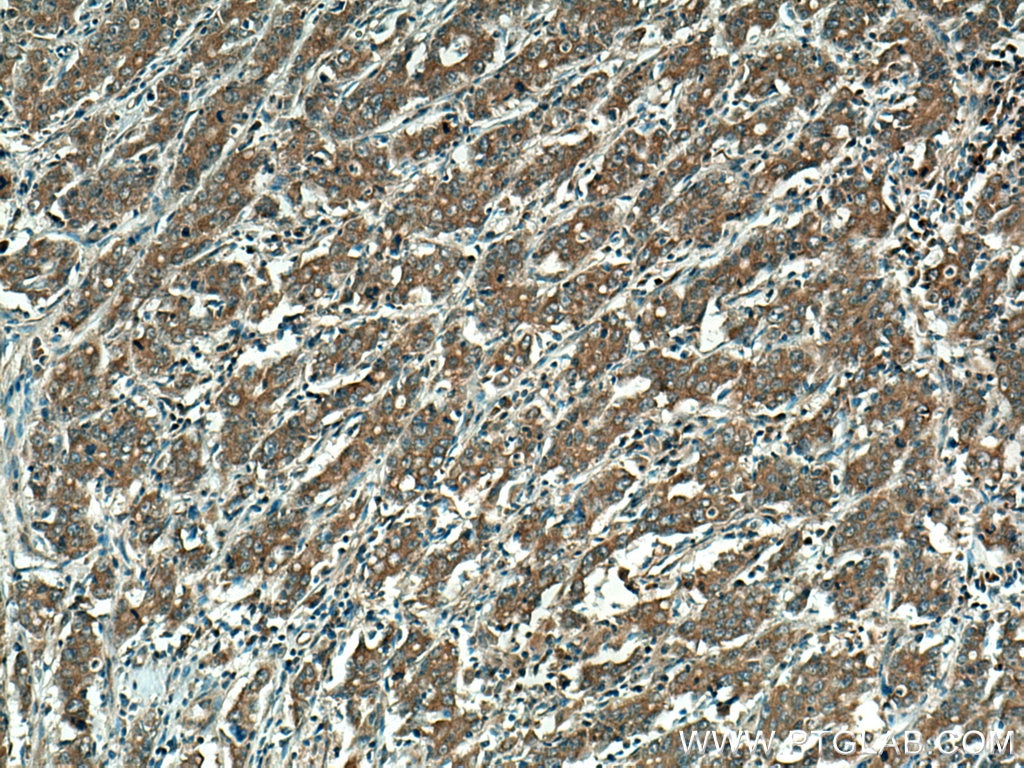Immunohistochemistry (IHC) staining of human stomach cancer tissue using RAB3IP Polyclonal antibody (12321-1-AP)