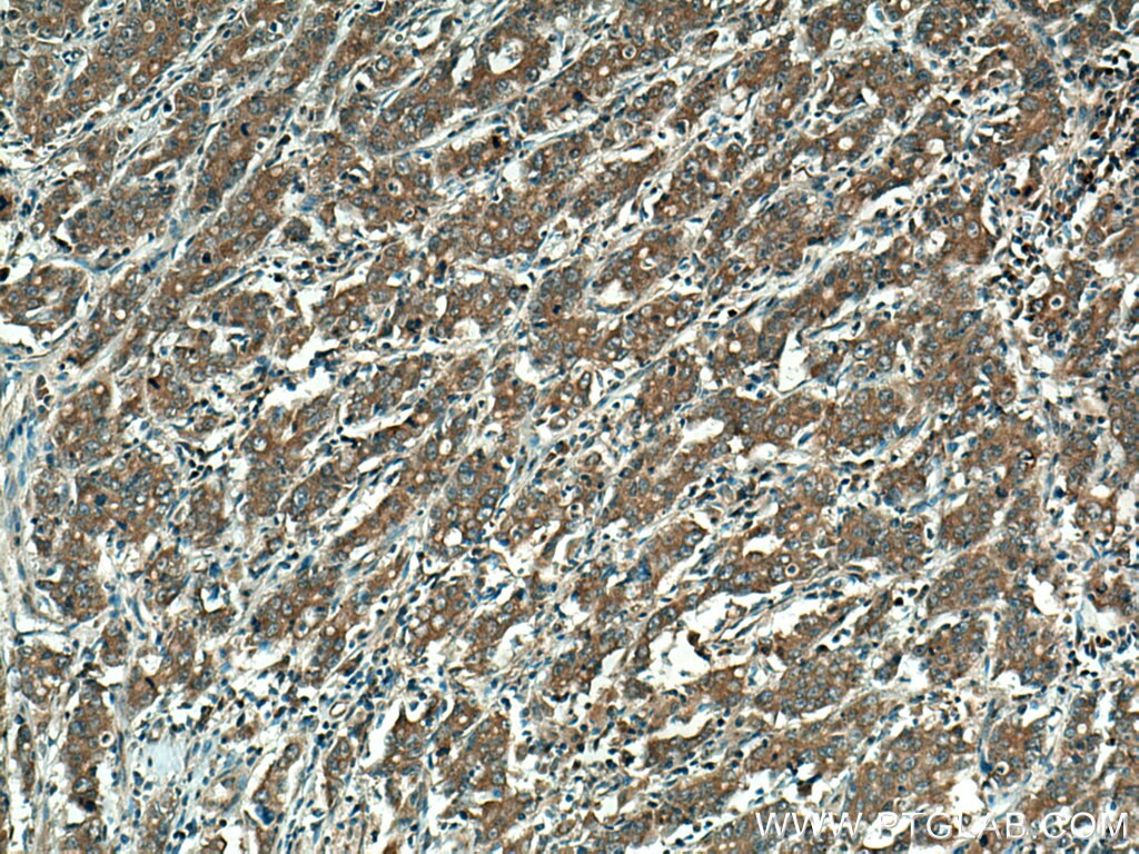 IHC staining of human stomach cancer using 12321-1-AP