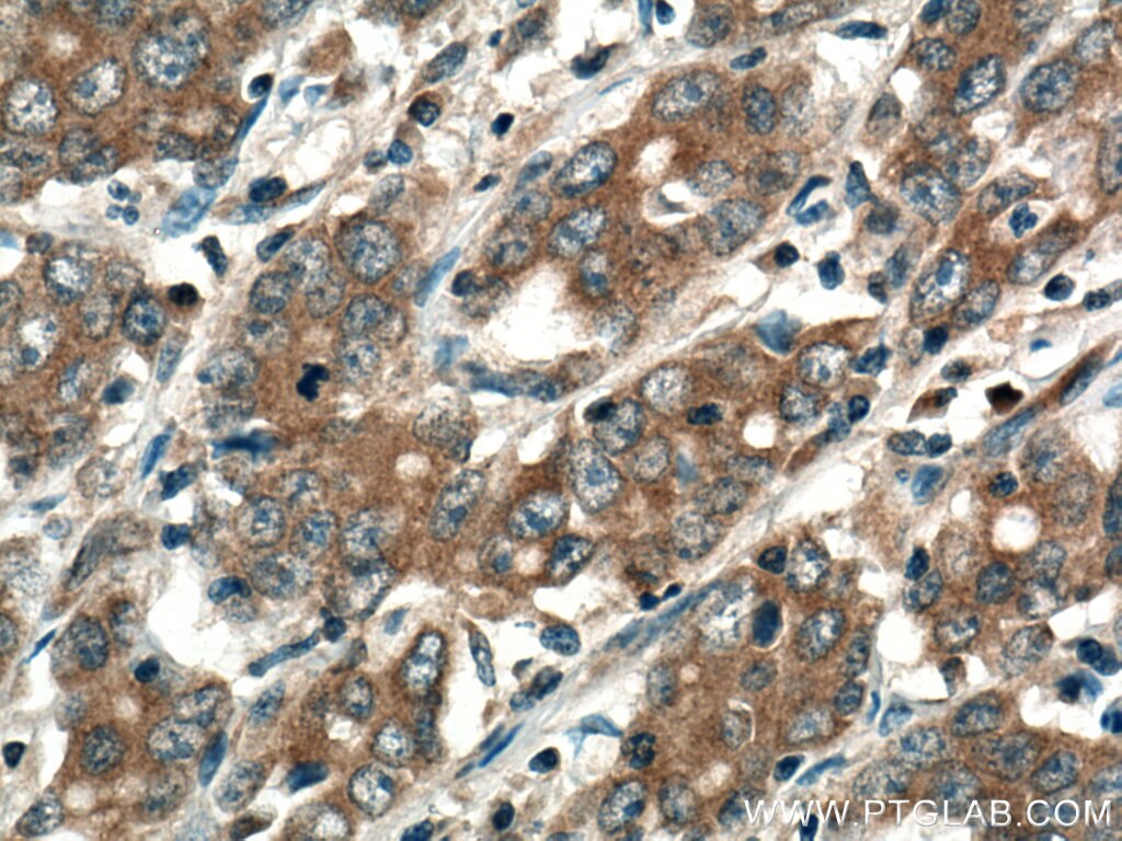 Immunohistochemistry (IHC) staining of human stomach cancer tissue using RAB3IP Polyclonal antibody (12321-1-AP)