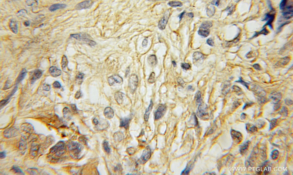 Immunohistochemistry (IHC) staining of human gliomas tissue using RAB40B Polyclonal antibody (12471-1-AP)