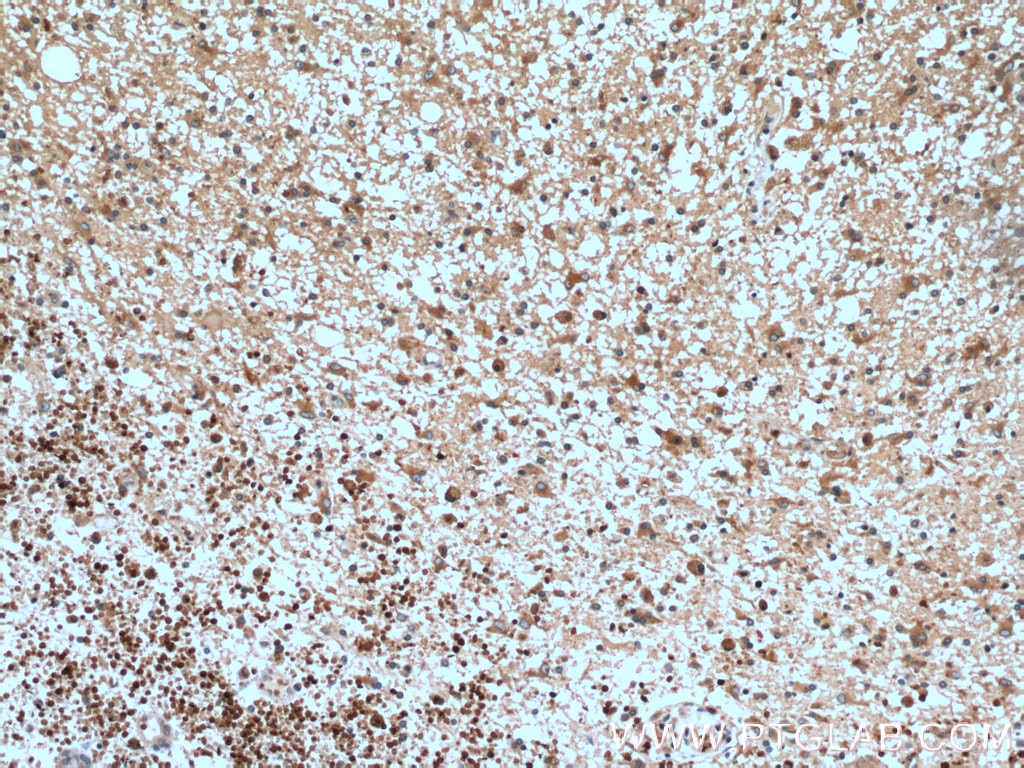 Immunohistochemistry (IHC) staining of human gliomas tissue using RAB5A Polyclonal antibody (11947-1-AP)