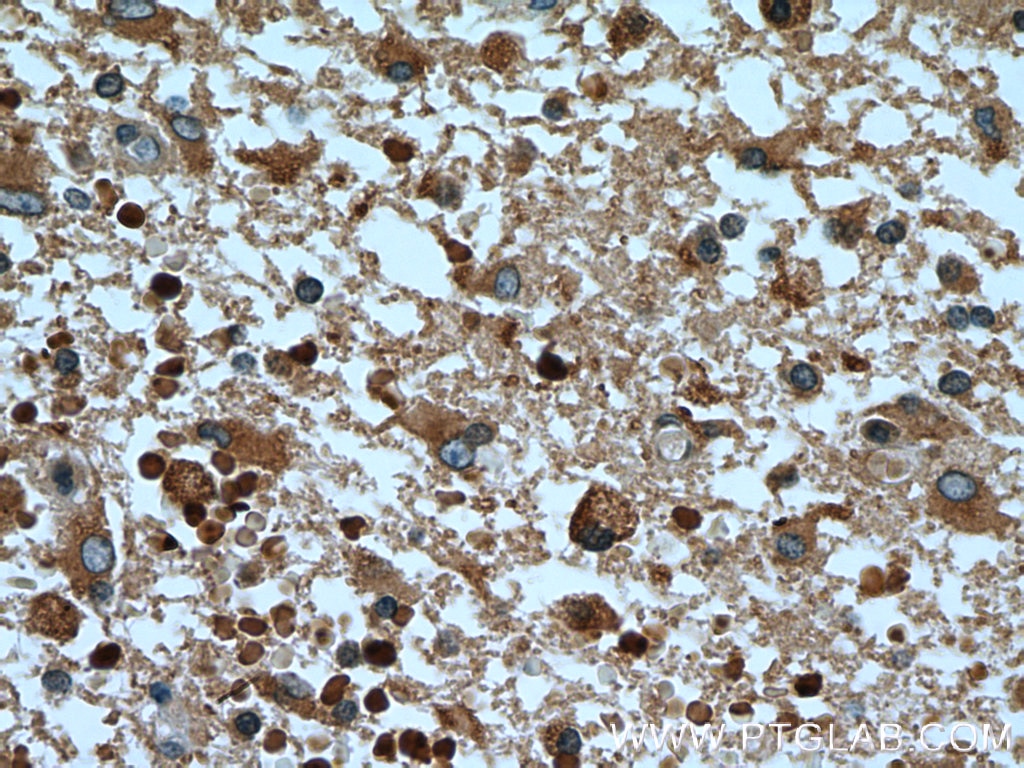 Immunohistochemistry (IHC) staining of human gliomas tissue using RAB5A Polyclonal antibody (11947-1-AP)