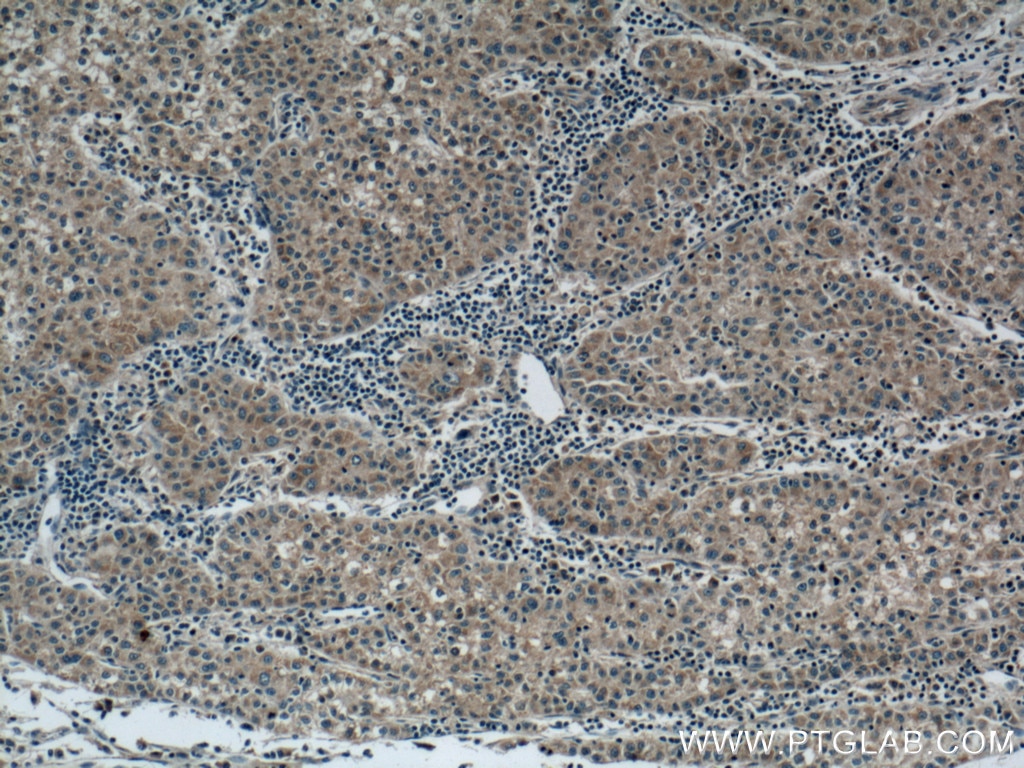 Immunohistochemistry (IHC) staining of human liver cancer tissue using RAB5A Monoclonal antibody (66339-1-Ig)