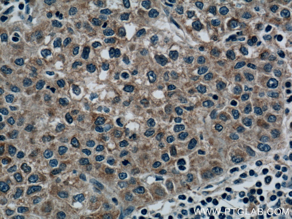 Immunohistochemistry (IHC) staining of human liver cancer tissue using RAB5A Monoclonal antibody (66339-1-Ig)