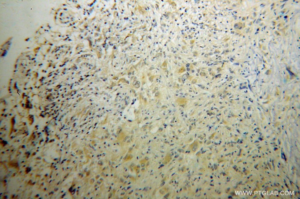 Immunohistochemistry (IHC) staining of human gliomas tissue using RAB6B Polyclonal antibody (10340-1-AP)