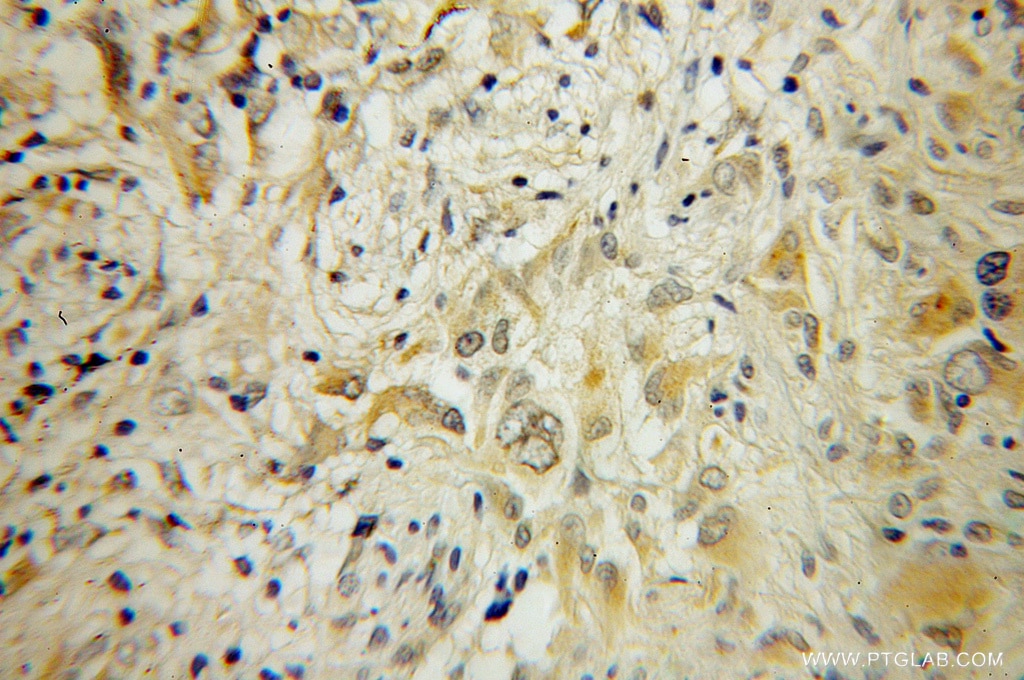 IHC staining of human gliomas using 10340-1-AP