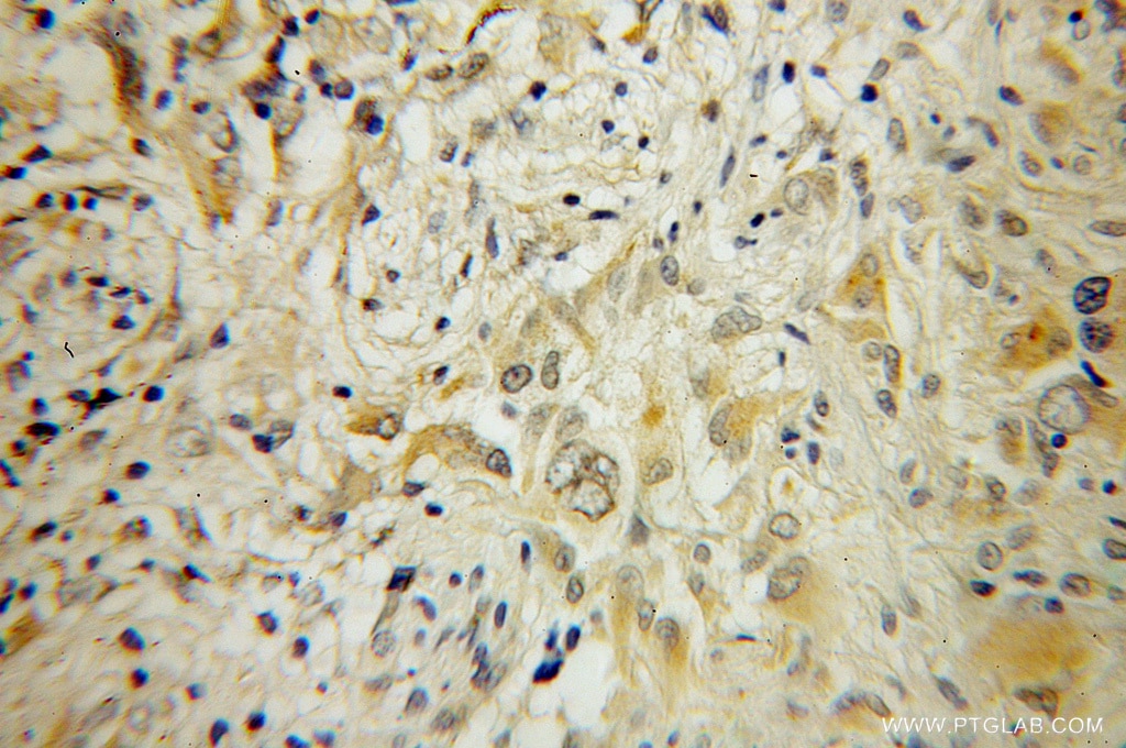 Immunohistochemistry (IHC) staining of human gliomas tissue using RAB6B Polyclonal antibody (10340-1-AP)