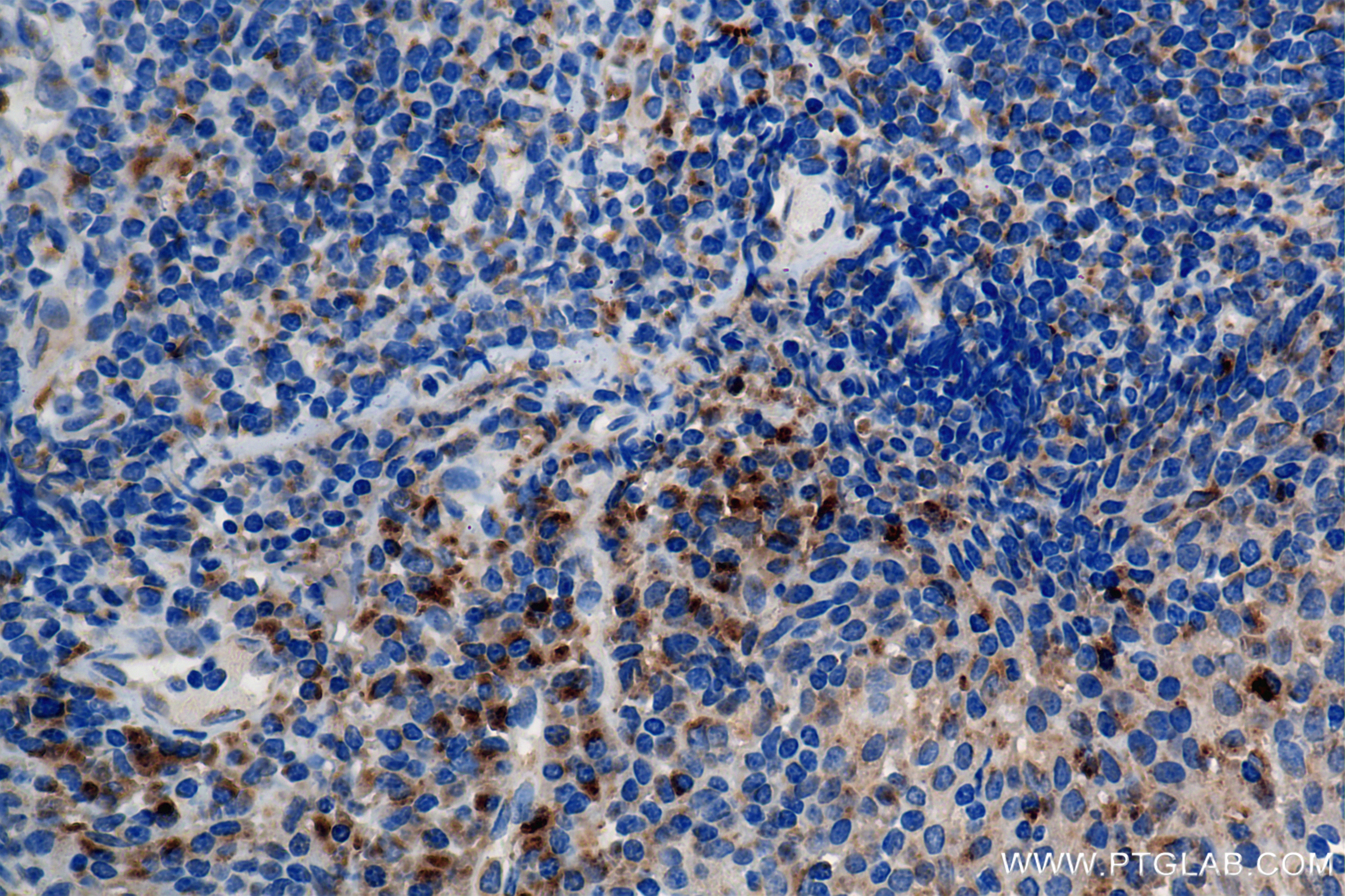 Immunohistochemical analysis of paraffin-embedded human tonsil tissue slide using 84741-1-RR (RAB7A antibody) at dilution of 1:1000 (under 40x lens). Heat mediated antigen retrieval with Tris-EDTA buffer (pH 9.0). Immunohistochemistry (IHC) staining of human tonsil tissue using RAB7A Recombinant antibody (84741-1-RR)