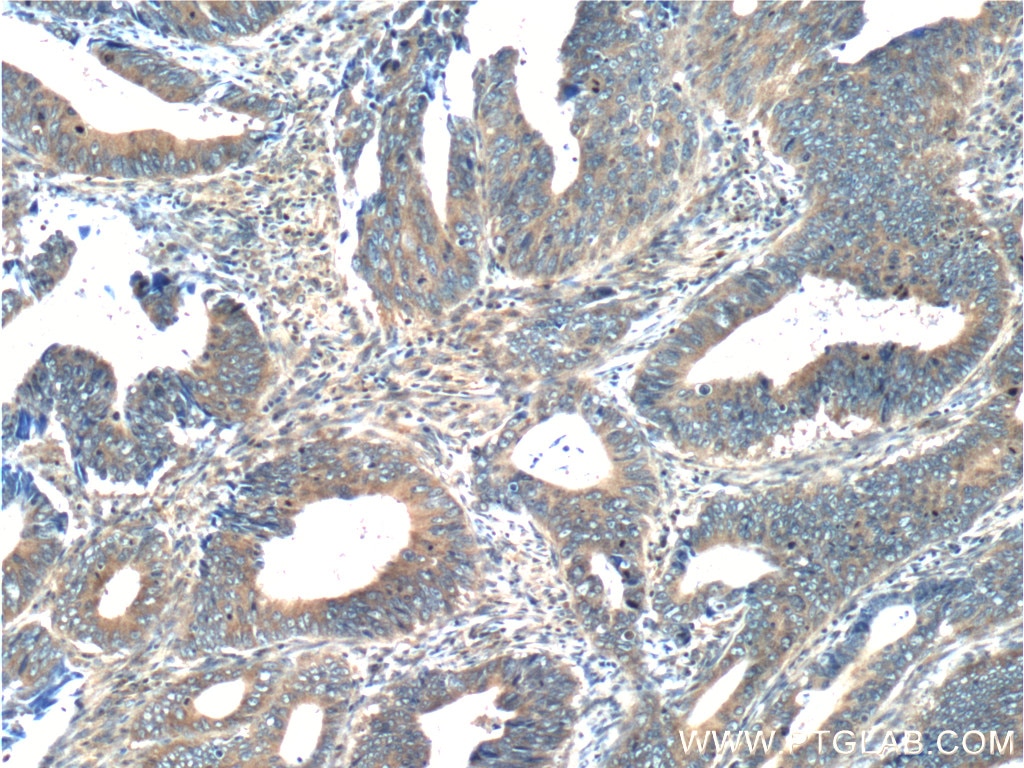 Immunohistochemistry (IHC) staining of human colon cancer tissue using RAB8A Polyclonal antibody (55296-1-AP)