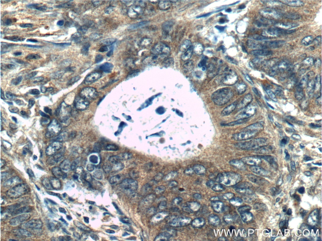 Immunohistochemistry (IHC) staining of human colon cancer tissue using RAB8A Polyclonal antibody (55296-1-AP)