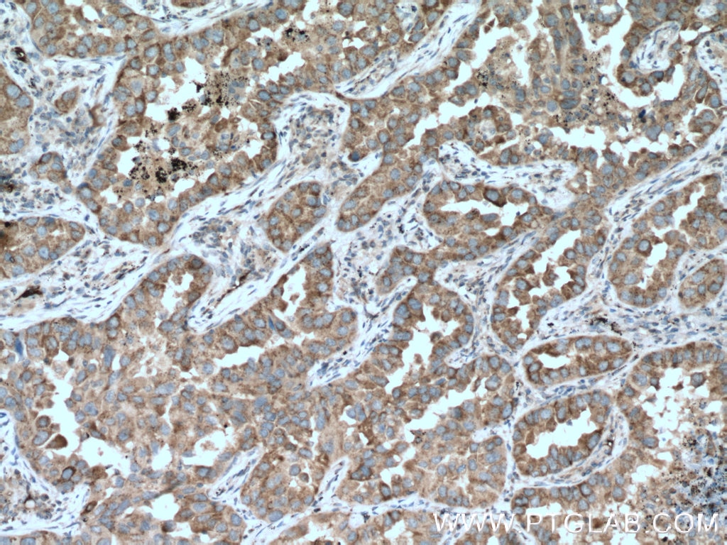 Immunohistochemistry (IHC) staining of human lung cancer tissue using RAB8 Polyclonal antibody (11792-1-AP)