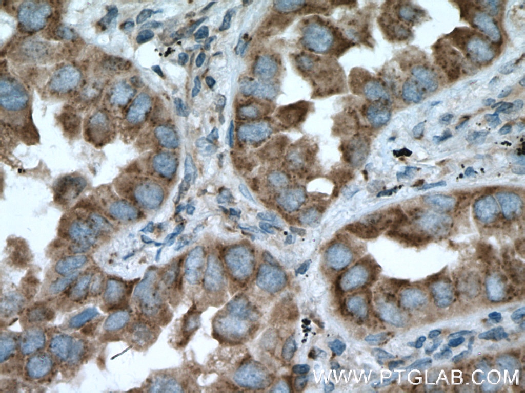 Immunohistochemistry (IHC) staining of human lung cancer tissue using RAB8 Polyclonal antibody (11792-1-AP)