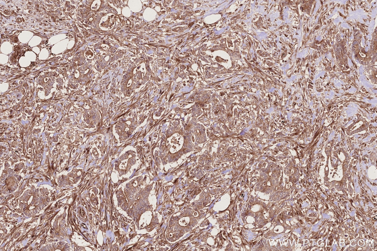 Immunohistochemistry (IHC) staining of human rectal cancer tissue using RAB8 Polyclonal antibody (11792-1-AP)