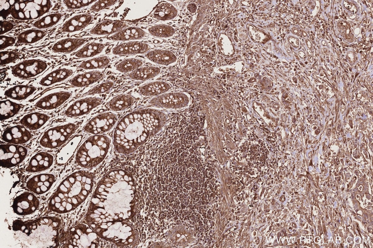 Immunohistochemistry (IHC) staining of human rectal cancer tissue using RAB8 Polyclonal antibody (11792-1-AP)