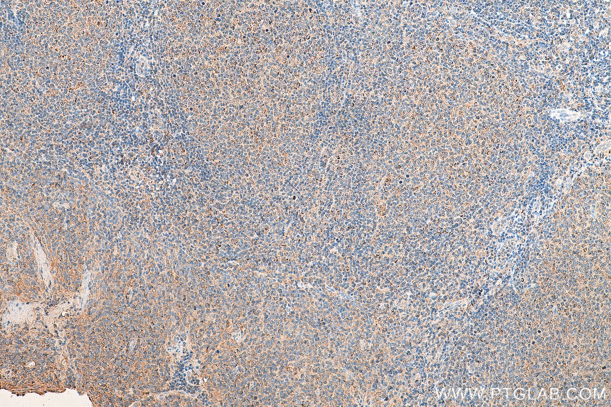 IHC staining of human tonsillitis using 11420-1-AP