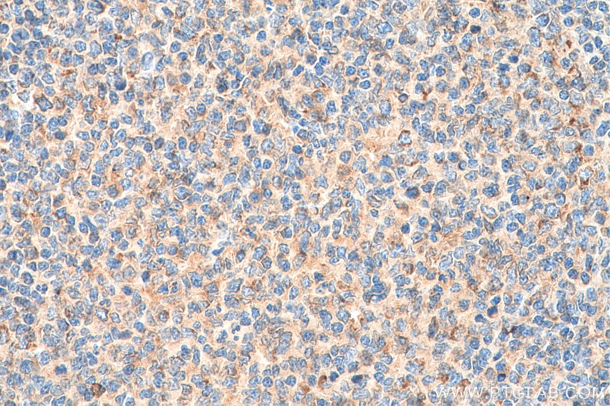Immunohistochemistry (IHC) staining of human tonsillitis tissue using RAB9A Polyclonal antibody (11420-1-AP)