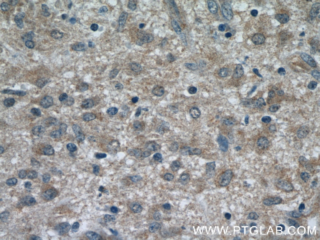 Immunohistochemistry (IHC) staining of human gliomas tissue using RAB9A-Specific Polyclonal antibody (18719-1-AP)