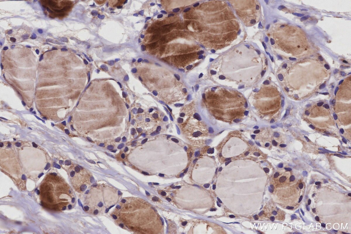 IHC staining of human thyroid cancer using 68031-1-Ig Immunohistochemistry (IHC) staining of human thyroid cancer tissue using RAB9B Monoclonal antibody (68031-1-Ig)