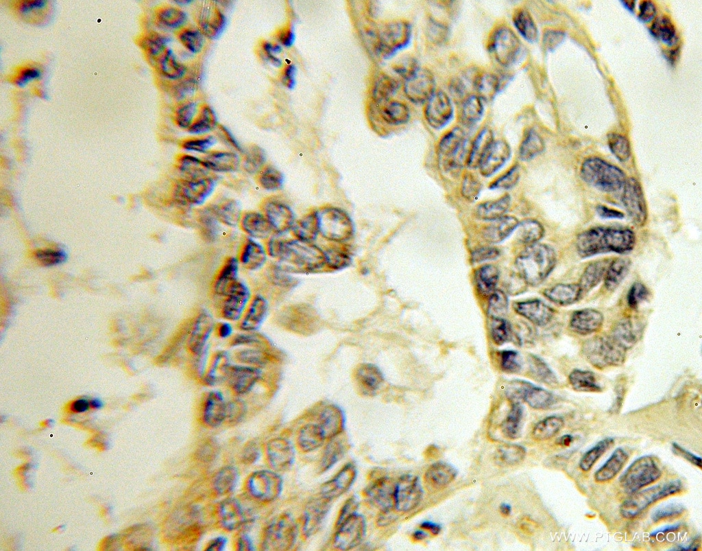 IHC staining of human pancreas cancer using 10542-1-AP