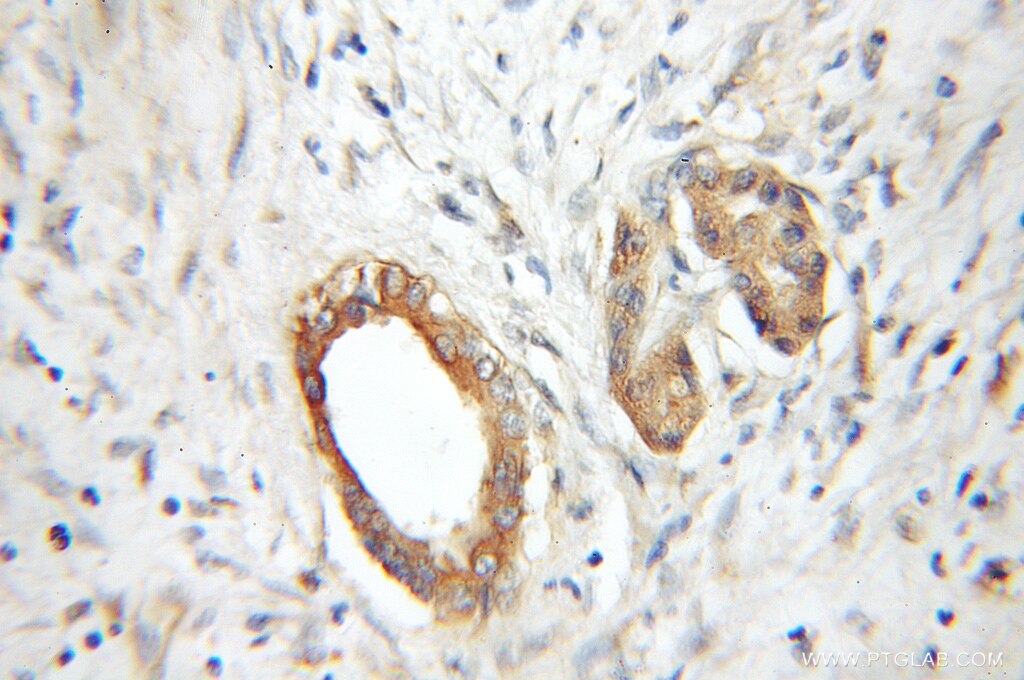 Immunohistochemistry (IHC) staining of human pancreas cancer tissue using RABAC1 Polyclonal antibody (10542-1-AP)