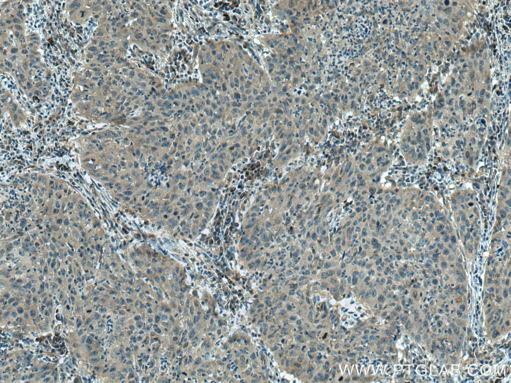 Immunohistochemistry (IHC) staining of human cervical cancer tissue using RABEP2 Polyclonal antibody (14625-1-AP)