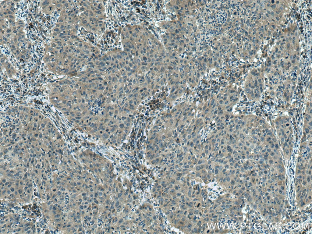 IHC staining of human cervical cancer using 14625-1-AP