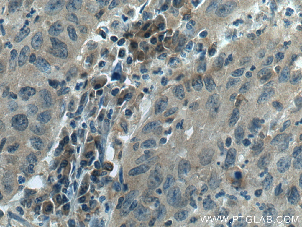 Immunohistochemistry (IHC) staining of human cervical cancer tissue using RABEP2 Polyclonal antibody (14625-1-AP)