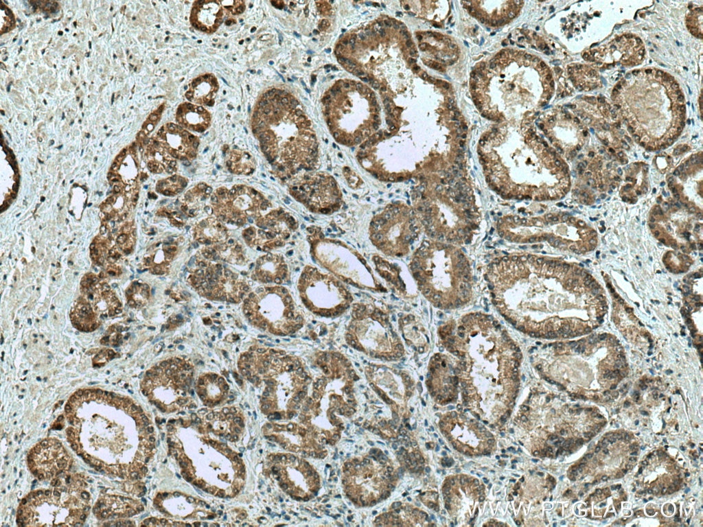 Immunohistochemistry (IHC) staining of human prostate cancer tissue using RABEP2 Polyclonal antibody (14625-1-AP)