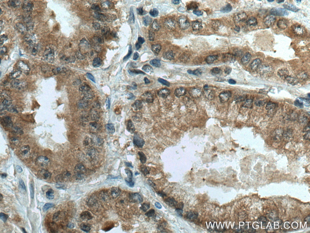 Immunohistochemistry (IHC) staining of human prostate cancer tissue using RABEP2 Polyclonal antibody (14625-1-AP)