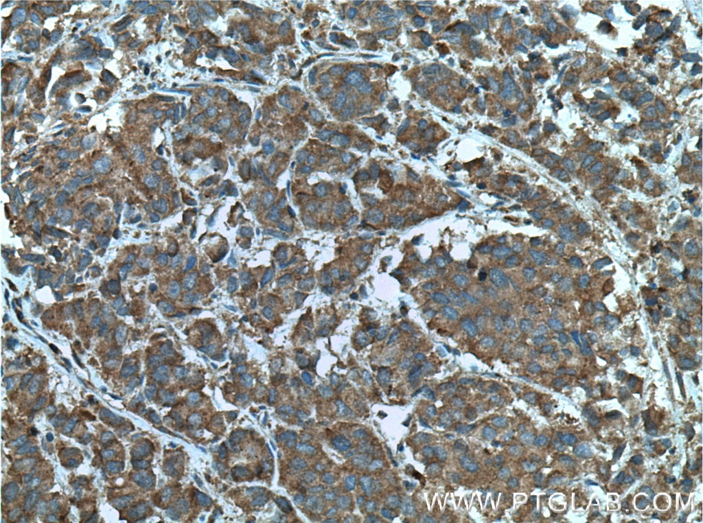 Immunohistochemistry (IHC) staining of human prostate cancer tissue using RABEP2 Monoclonal antibody (60125-1-Ig)