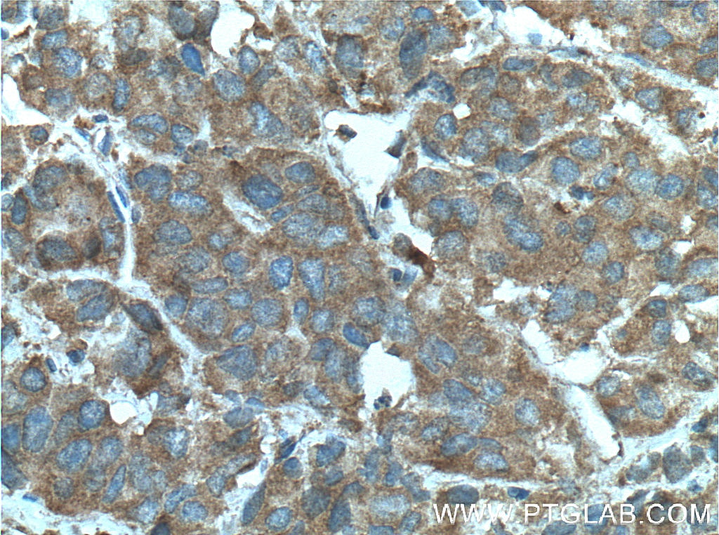 Immunohistochemistry (IHC) staining of human prostate cancer tissue using RABEP2 Monoclonal antibody (60125-1-Ig)