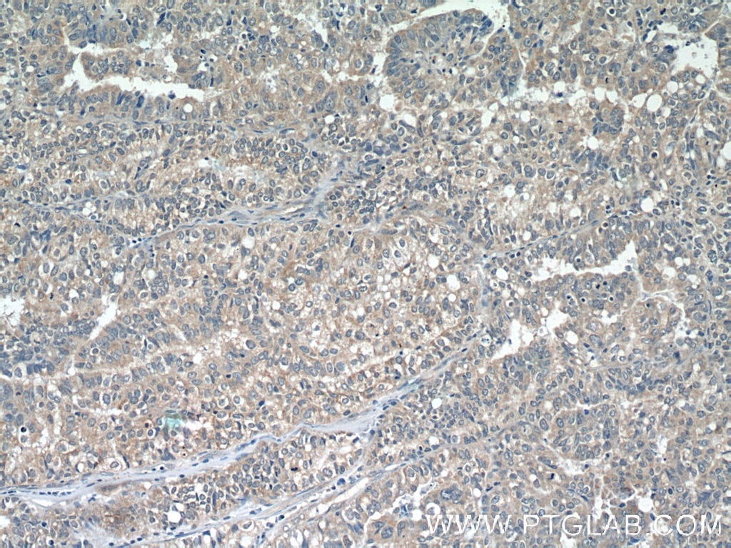 Immunohistochemistry (IHC) staining of human breast cancer tissue using RABEP2 Monoclonal antibody (60125-1-Ig)