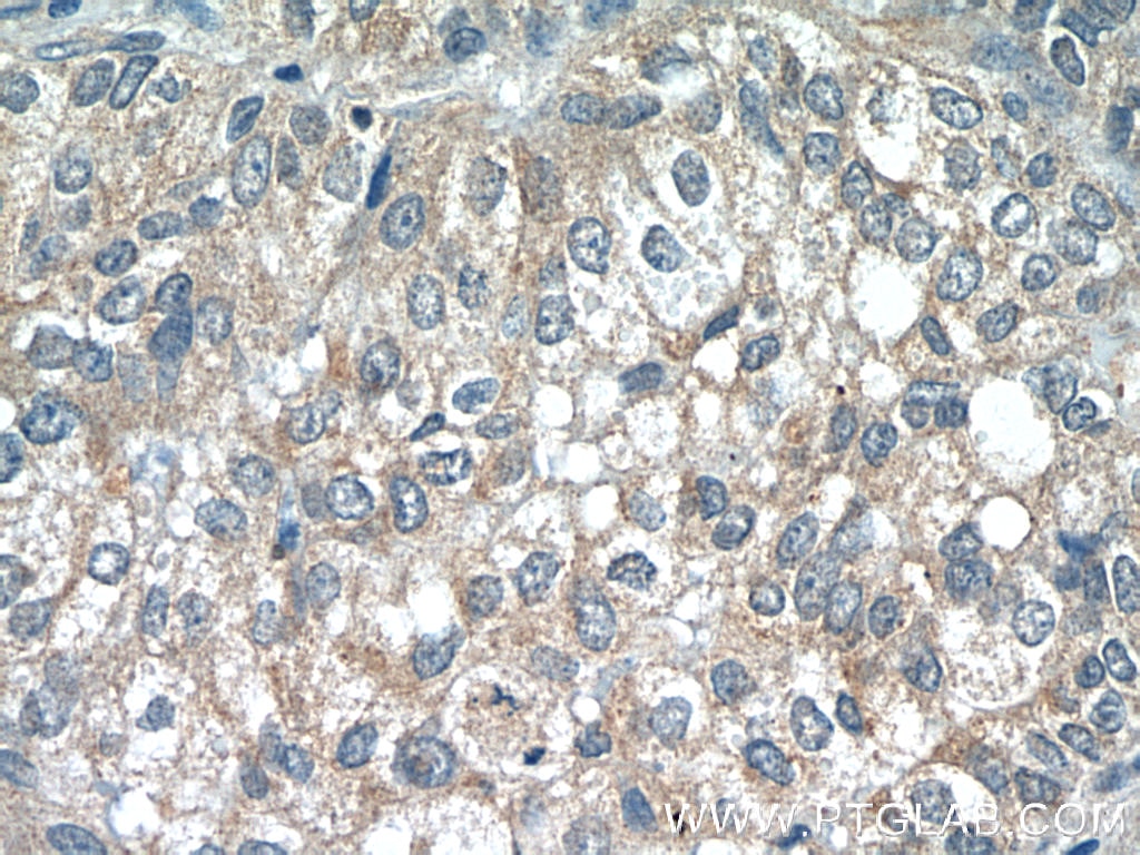 Immunohistochemistry (IHC) staining of human breast cancer tissue using RABEP2 Monoclonal antibody (60125-1-Ig)