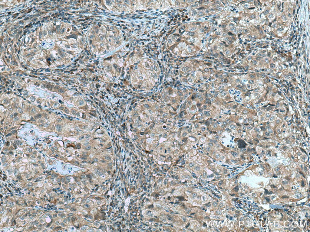 Immunohistochemistry (IHC) staining of human lung cancer tissue using RABEPK/p40 Polyclonal antibody (10213-2-AP)