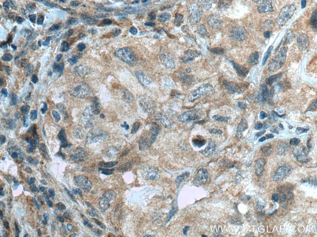 Immunohistochemistry (IHC) staining of human lung cancer tissue using RABEPK/p40 Polyclonal antibody (10213-2-AP)