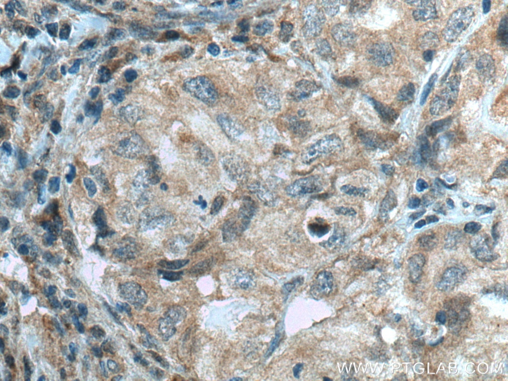 IHC staining of human lung cancer using 10213-2-AP