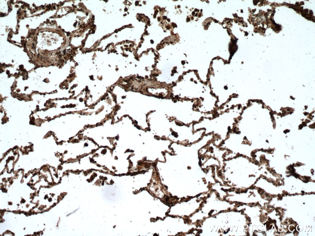 IHC staining of human lung cancer using 15105-1-AP