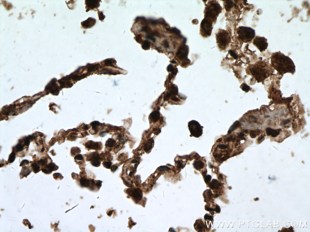 Immunohistochemistry (IHC) staining of human lung cancer tissue using RABEPK/p40 Polyclonal antibody (15105-1-AP)