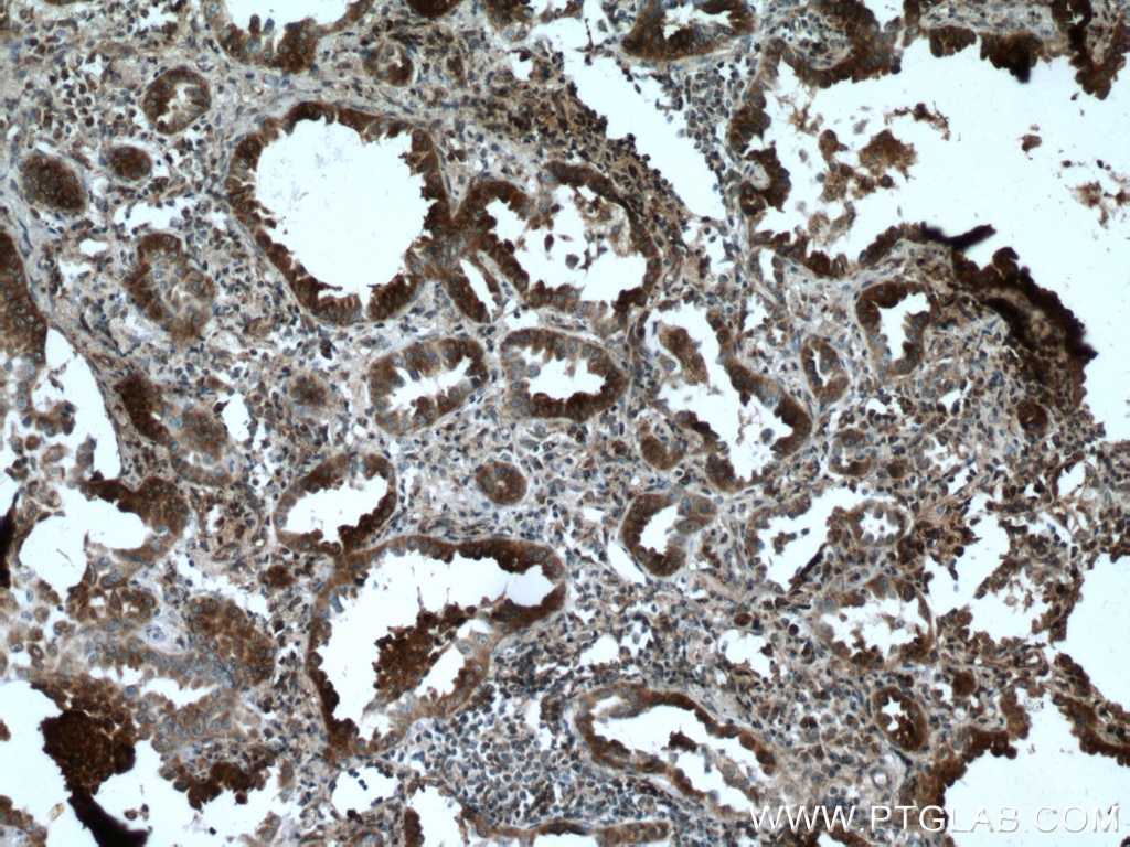 Immunohistochemistry (IHC) staining of human lung cancer tissue using RABEPK/p40 Polyclonal antibody (15105-1-AP)