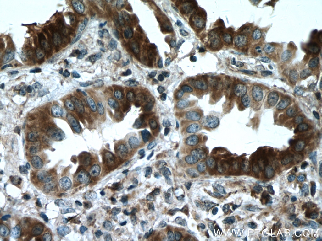 Immunohistochemistry (IHC) staining of human lung cancer tissue using RABEPK/p40 Polyclonal antibody (15105-1-AP)